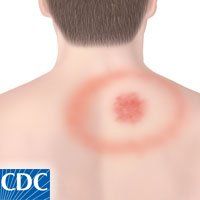 Lyme_Disease_Symptoms