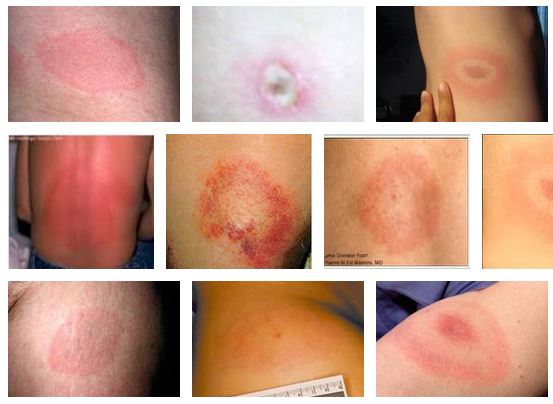 lyme-rash-photo