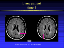 lyme diasease and the brain